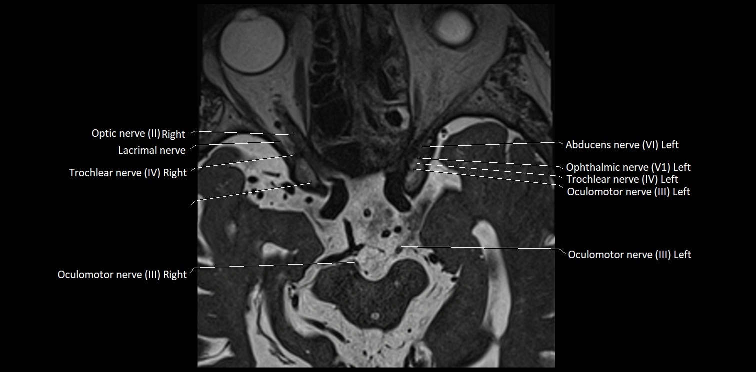 Cranial nerve anatomy axial MRI 3T image 18.webp